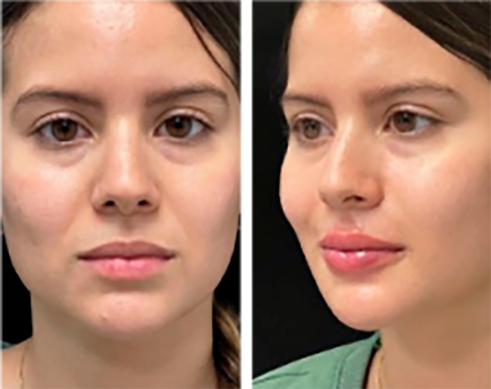 Aumento de labios medicina estetica en Cali