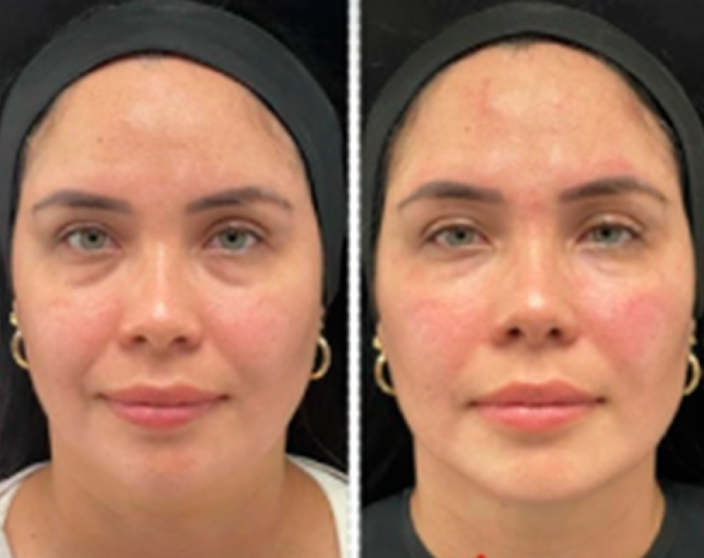 Dra Andrea Vidal medicina estetica en Cali Acido Hialuronico