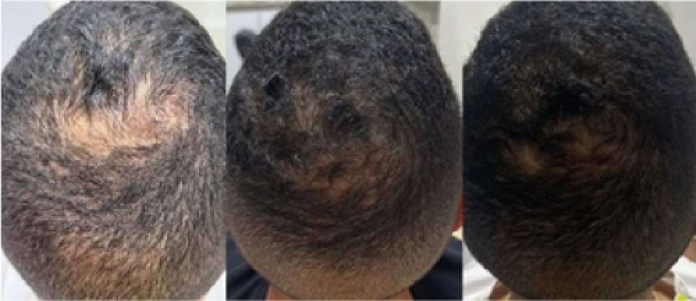 Tratamiento alopecia en Cali