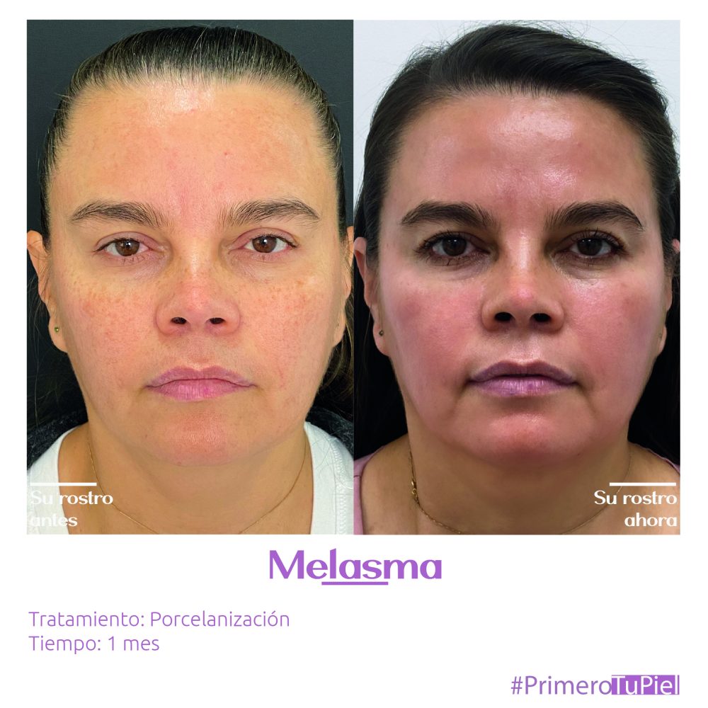 mesoterapiayporcelanizacion_Mesa de trabajo 1.jpg